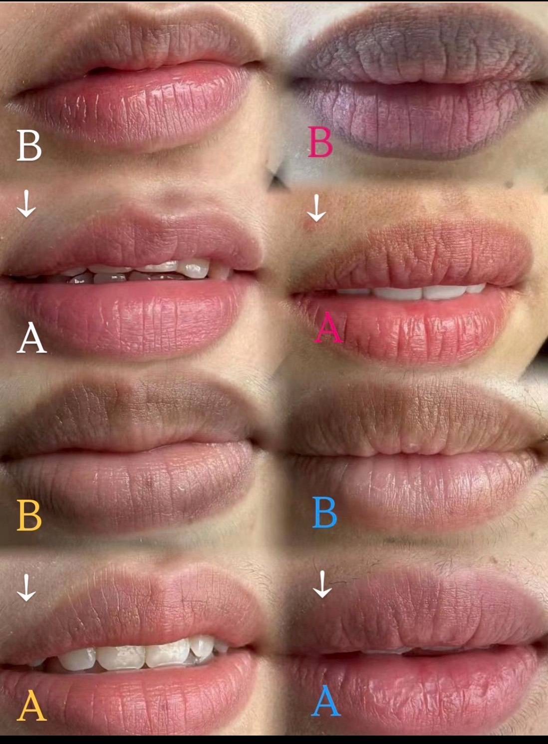 シンガポール ドールピンク メラニンケア